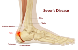 Severs Disease